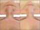 ロージースマイル(Rosy smile)の写真/黒ずみ・詰まりごっそり除去!透明肌へ♪ 【ハイドラ美容液毛穴洗浄】【韓国発 XE`LHAPeel (セラピール】
