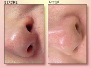 ジュリア オージェ 四条河原町店/ビフォーアフター（鼻スパ）