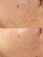 ラエッセ 恵比寿(LAESSE)/毛穴・美白専門店 LAESSE 恵比寿