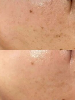 ラエッセ 恵比寿(LAESSE)/毛穴・美白専門店 LAESSE 恵比寿