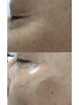 トリアングル(TLIENGLE)/ララピール before after