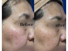 ヒール(heal)/症例