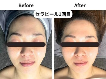 ビー(Be.)/セラピール1回の効果