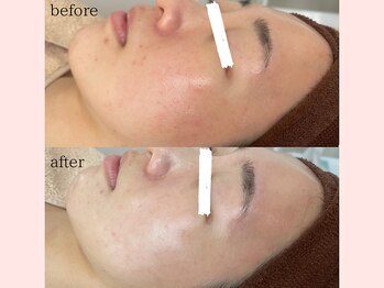 サロン モア(salon more)/美白ケア