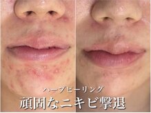 ホワイトアクア 岐阜店(WHITE AQUA)/ハーブピーリング/岐阜/ニキビ