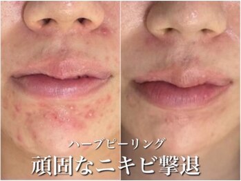 ホワイトアクア 岐阜店(WHITE AQUA)/ハーブピーリング/岐阜/ニキビ