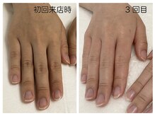 キレイテ 福岡天神店/40代/回目【博多ハンドケア】