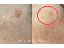 カミーシャ(KaMi-Sha)/【60代女性】シミケア症例写真