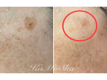 カミーシャ(KaMi-Sha)/【60代女性】シミケア症例写真