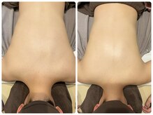 ブリリアント(Brilliant)/背中ブライダルシェービング