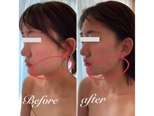 美バストアルファ(美bust α)/【小顔コルギ】症例