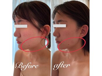 美バストアルファ(美bust α)/【小顔コルギ】症例