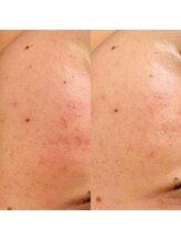 ラエッセ 恵比寿(LAESSE)/毛穴・美白専門店 LAESSE 恵比寿