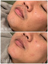 クラン 森ノ宮店(Clan)/髭脱毛