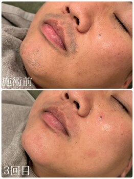 クラン 森ノ宮店(Clan)/髭脱毛 30代 男性