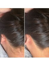 インベスト(INVEST)/うなじ脱毛