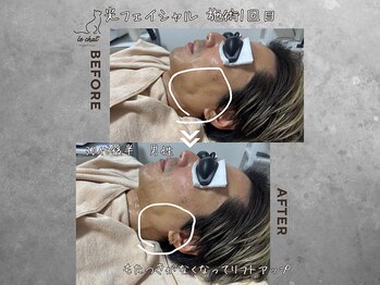 ル シャ/メンズ脱毛/毛穴洗浄/ヘッドスパ