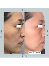 ジルフィー(GILFY)/医療提携の肌質改善フェイシャル