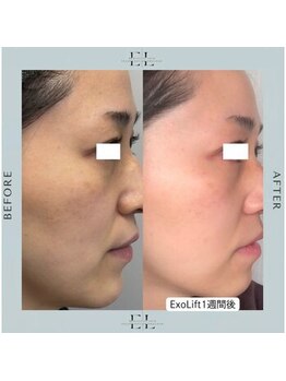 ジルフィー(GILFY)/医療提携の肌質改善フェイシャル