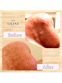 ウィズリリナ 新横浜(with Lilina.)/1回/毛穴洗浄/ハイドラ/新横浜