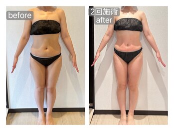 リラ(RILA)/キャビ+マッサージbefore after