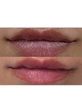 レティティア(Laetitia)/症例2【リップローマピンク】