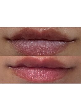 レティティア(Laetitia)/症例2【リップローマピンク】