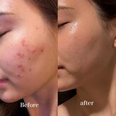 レイニゲン(H/Reinigen)