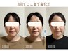 【たるみ・ほうれい線】リフトアップ小顔矯正★頭蓋骨矯正＆首肩こりケアまで