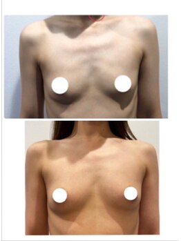 美人バスト 本厚木店/バストアップ◇症例◇