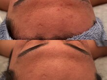 ポーデベロア(Peau des velours)/陶肌トリートメント/男性