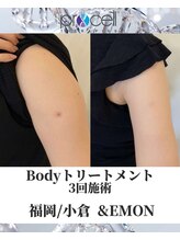 アンドエモン(&EMON)/【ボディ】プロセル効果