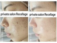 リセラージュ(Recellage)/陶肌トリートメント/ニキビケア
