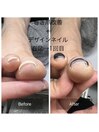巻き爪改善＋デザインネイル