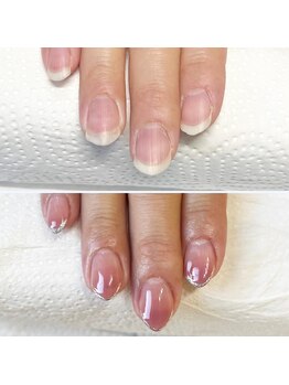 ジェルメ(germer)/癖のあるお爪のビフォーアフター