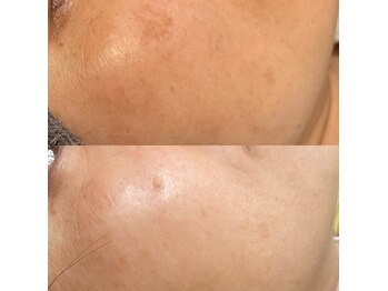 モルセラ(Moluccella)/12回の施術