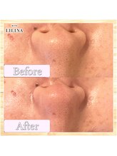 ウィズリリナ 新横浜(with Lilina.)/1回/毛穴洗浄/ハイドラ/新横浜