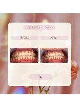プラスビー 2号店(+b)/ホワイトニングビフォーアフター