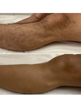 レヴール(reveur)/足脱毛[美容脱毛/新潟脱毛]