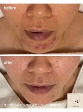 アトワ(A toi)/ハーブピーリング（棘あり）