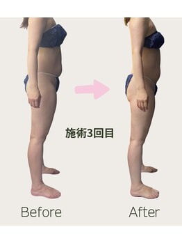 ネオボディ(Neo Body)/施術期間1ヶ月