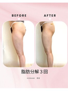 エルブラン(Herb ame)/下半身、痩せにくい方へ
