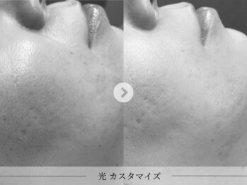 スパレーカ(Spa laka)/毛穴・凹凸ケア