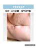【無料肌診断付】迷ったらこれ！プラズマ肌管理
