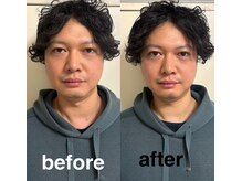 マホロバ(mahoroba)/メンズ美容鍼