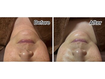 ルース(Luce)/圧倒的美白《シーズナルエステ》