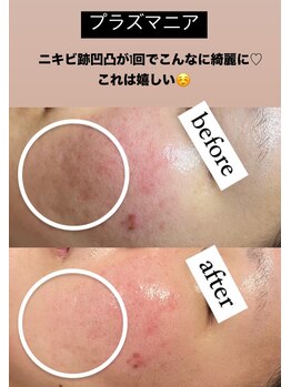 ビューティーネイル(Beauty Nail)/プラズマニア