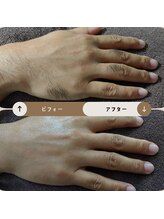 ジュゴン(Dugong)/手の全体脱毛（Before＆After）