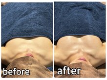 リルマコ/バスト症例写真