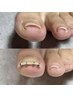 《つけた瞬間から違う！》巻爪矯正☆